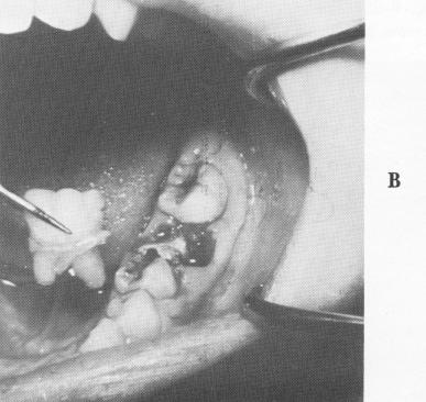 4 Lingual part of fractured lower tooth in bone, implant relevance