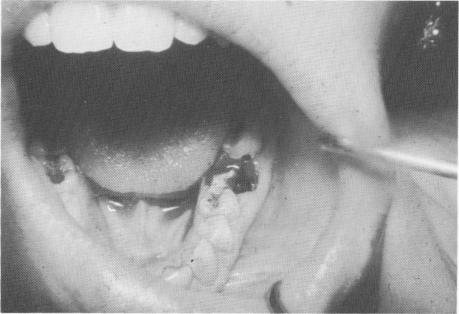 1 Vent-plant screwed to interseptal bone,buccal to lingual half of tooth