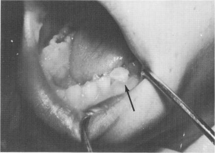2 Vent plant endosseous implant notched for retention of acrylic core