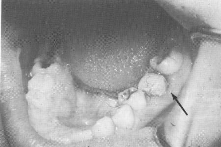 3 Vent plant implant acrylic core prepared for full crown restoration