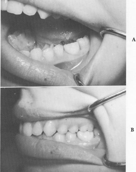 4 Gold-and-acrylic crown cemented on acrylic core, locks implant to bone