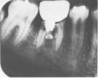1 Xray shows lower vent plant implant, tooth has split exactly at center