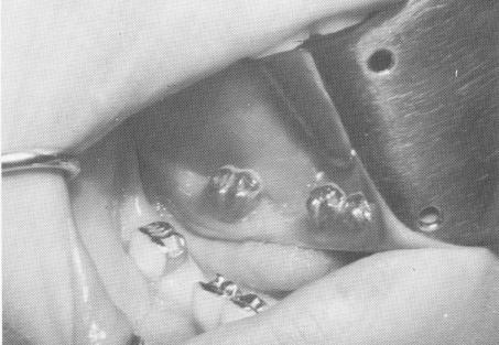 2 Class II inlay gold preparations on posterior teeth, implant relevance
