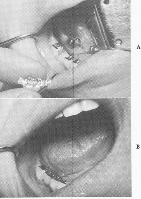 3 Restoration in position prior to implant insertion, accuracy checked