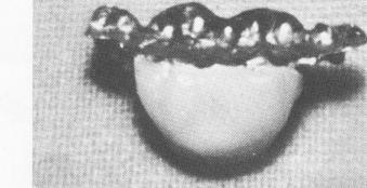 4 Vent-plant implant with Dacron sleeve attached, screwed into bone