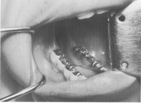 1 Prosthesis cemented over vent plant post and tooth inlay preparation