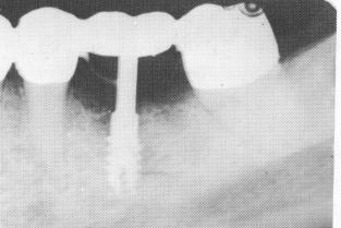 2 Xrays of prefabricated restoration in bridge, supporting implant