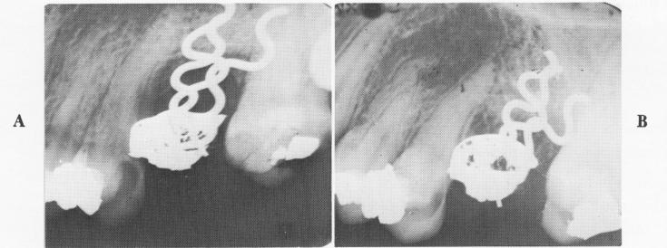 1 Radiograph of endosseous triplant pins inserted in open socket 