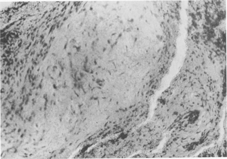 2 Connective tissue with numerous histiocytes at Formiggini implant site