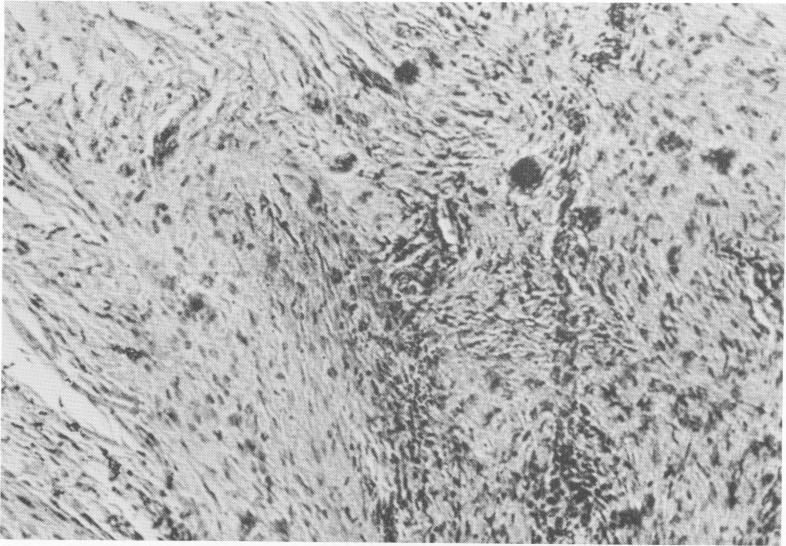 2 Fibrocytes and plasmodial elements at Formiggini implant site