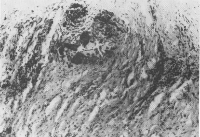 1 Fibrous tissue segment with cell elements at Formiggini implant site
