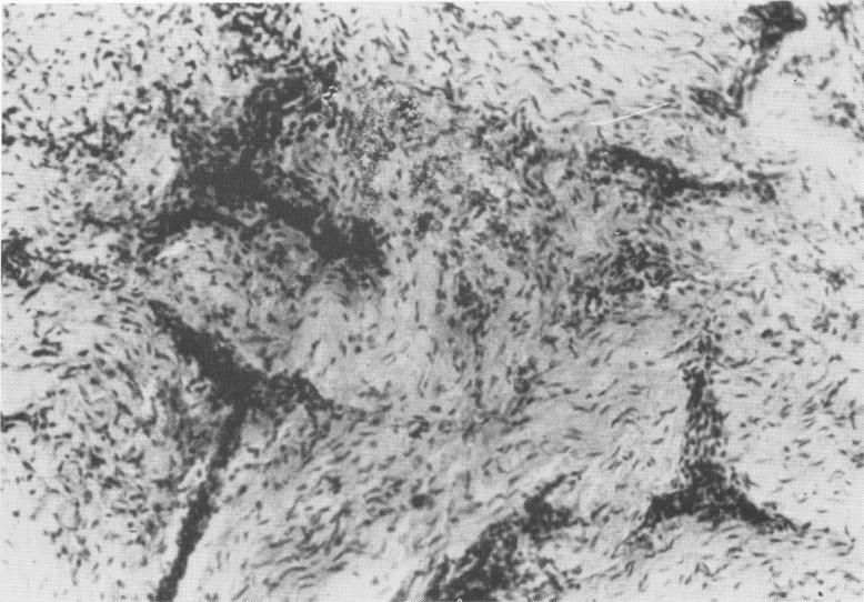 2 Fibrocytic connective tissues around endosseous Formiggini type implant