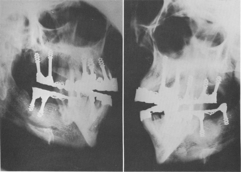 1 Chercheve`s spiral-post endosseous implants in mandible and maxillae