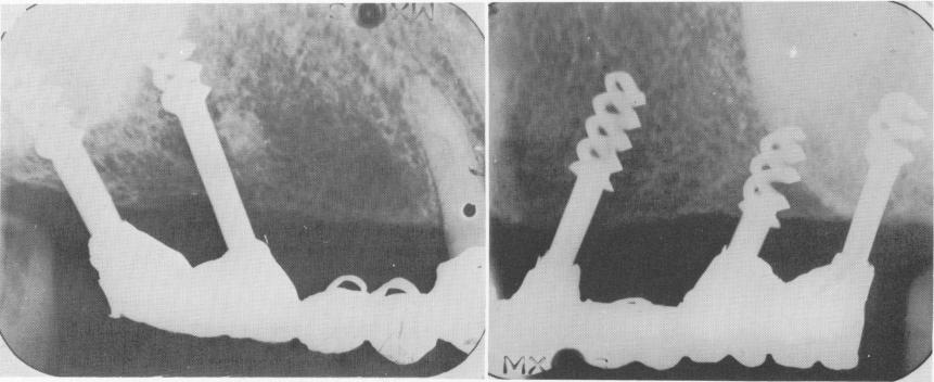 2 Xray of Chercheve`s spiral post implants in bone with no pathology