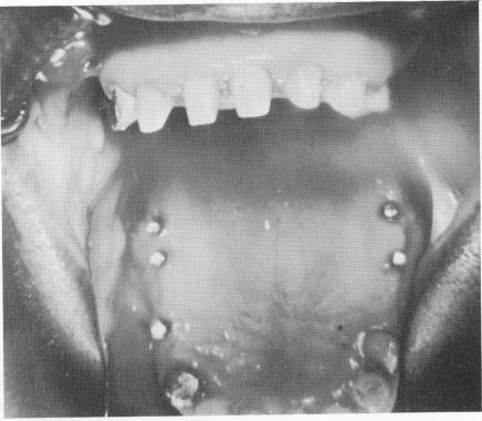 1 Healthy tissues under pontics around Chercheve`s spiral-post implants