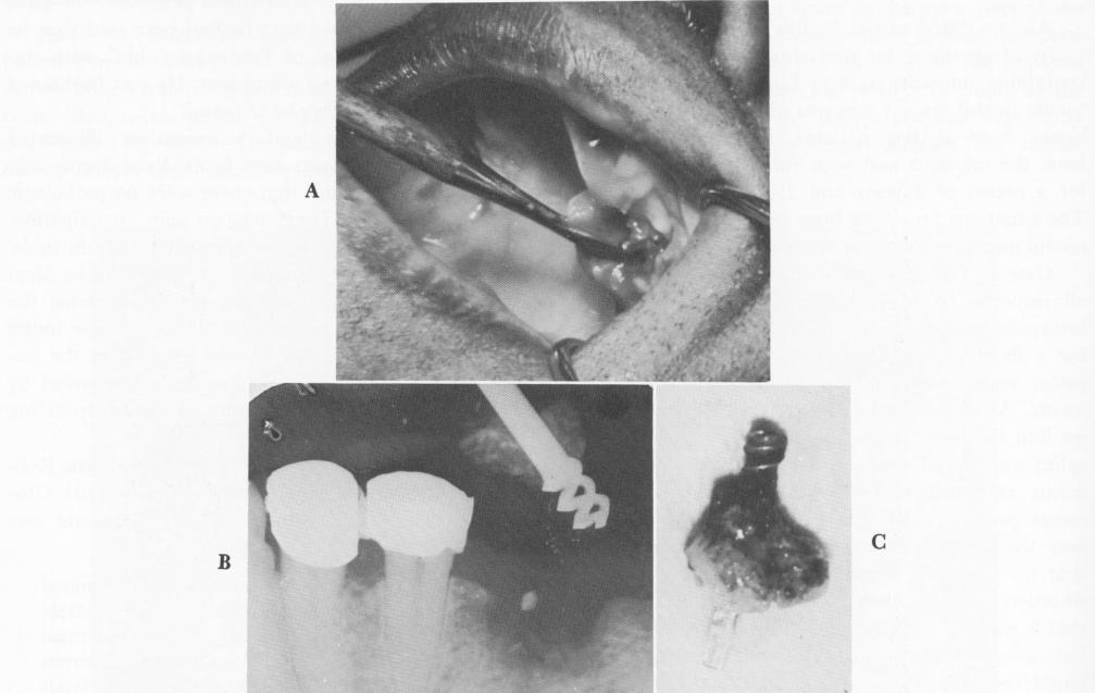 1 Chercheve`s spiral-post implant removed by cutting away alveolar bone