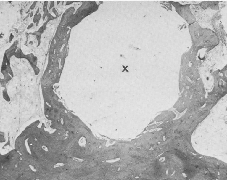 1 Clinical view prior to Chercheve endosseous spiral-post implantation