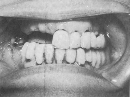 2 Impacted upper cuspid with little bone between antral floor and tooth