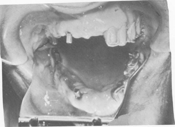 1 Insertion of three Chercheve endosseous spiral-post implant