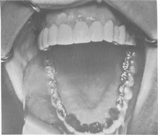 2 Final prosthesis placed over Chercheve endosseous spiral-post implant