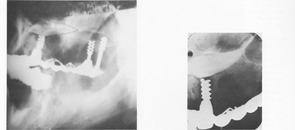 2 Lateral plate Xray shows two secure Chercheve spiral-post implants 