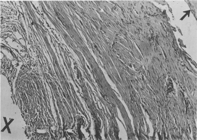 2 Dense and regular connective tissue near Chercheve spiral post implant