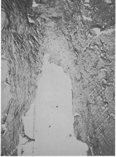 1 Histologic section from a failing Chercheve spiral-post implant