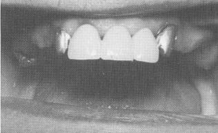 2 Maxillary right posterior quadrant cemented into position 