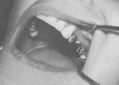 3 Dental pin implants drilled into bone, passing through template