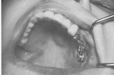 4 Acrylic cores are built up to affix the dental pins together