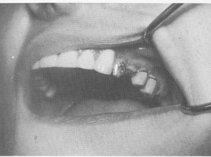 5 Superstructure is cemented over the maxillary template