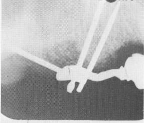1 X ray showing dental pins drilled through template & superstructure 