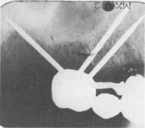 2 Prefabricated full arch fixed denture made using Hanau articulator