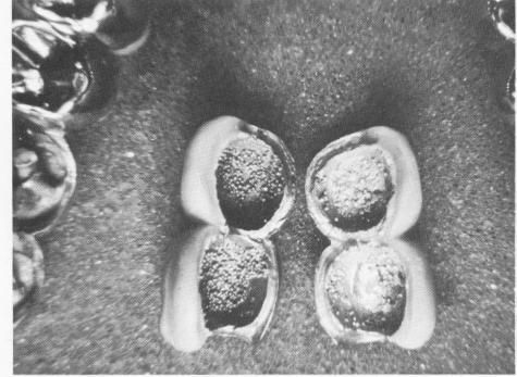 1 Maxillary superstructure castings cast with masses of tiny bubbles