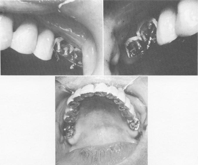 3 Dental pins set in template between vertical mushroom like pin heads