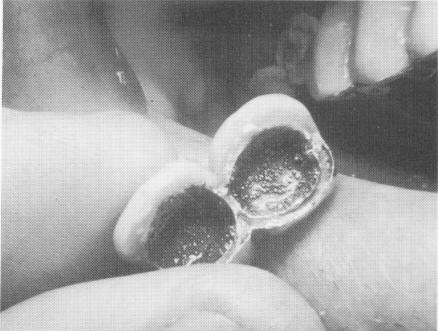 1 Superstructures cemented over acrylic cores made on dental pin implant