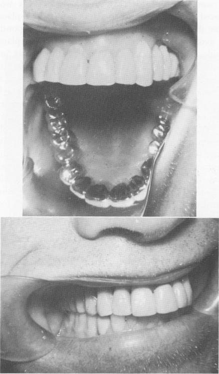 2 Ventplants & spreaded tripodial pins avoiding maxillary sinus