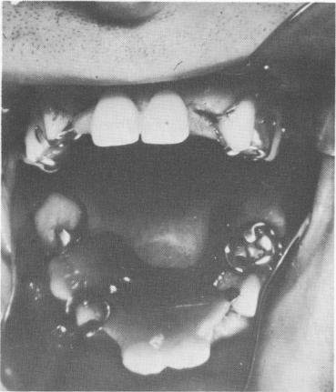 1 Broken removable partial denture with lateral incisor teeth missing