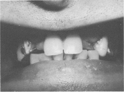 2 Teeth prepared for full crown restoration & transfer copings fitted 