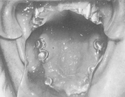 1 Plaster index of upper jaw taken, picking up all of the copings