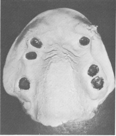 2 Maxillary mesostructure & superstructure seen with master stone model