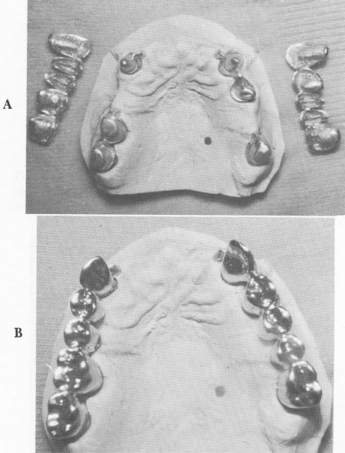 3 Superstructures fitted over mesostructures on maxillary stone model