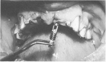4 Mesostructures fitted in mouth over maxillary prepared teeth