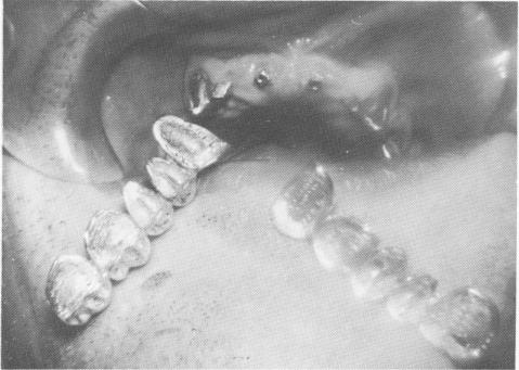 5 Internally threaded ventplants screwed into upper incisor regions