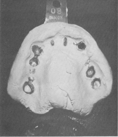1 Plaster index picked superstructure & mesostructure from upper jaw