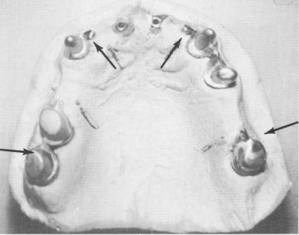 2 Oblique channels at strategic areas in mesostructure on maxillary model
