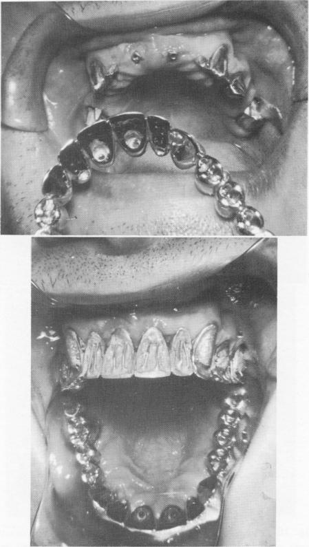 3 Soldered maxillary full arch denture tried in position