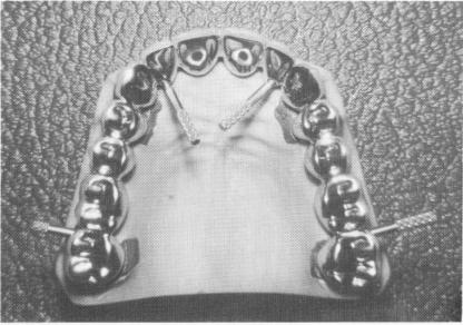 1 Small set screws secure maxillary superstructure to the mesostructure