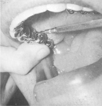 2 Special screwdrivers tighten small set screws of maxillary prosthesis