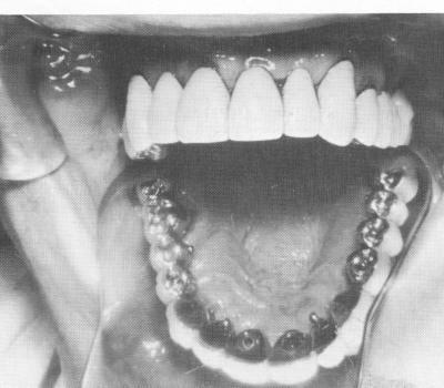 3 Maxillary superstructure in place